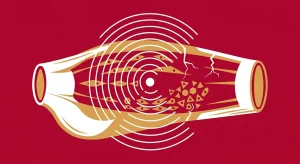 How to Load Tendons Safely After Shockwave Therapy