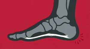 Shockwave Therapy for Plantar Fasciitis: What to Expect