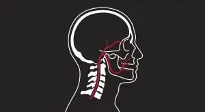 Can Chiropractic Care Resolve TMJ and Cervicogenic Headaches When Dental Splints Fail?