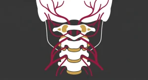 How to Differentiate Between a Migraine, TMD, and a Cervicogenic Headache